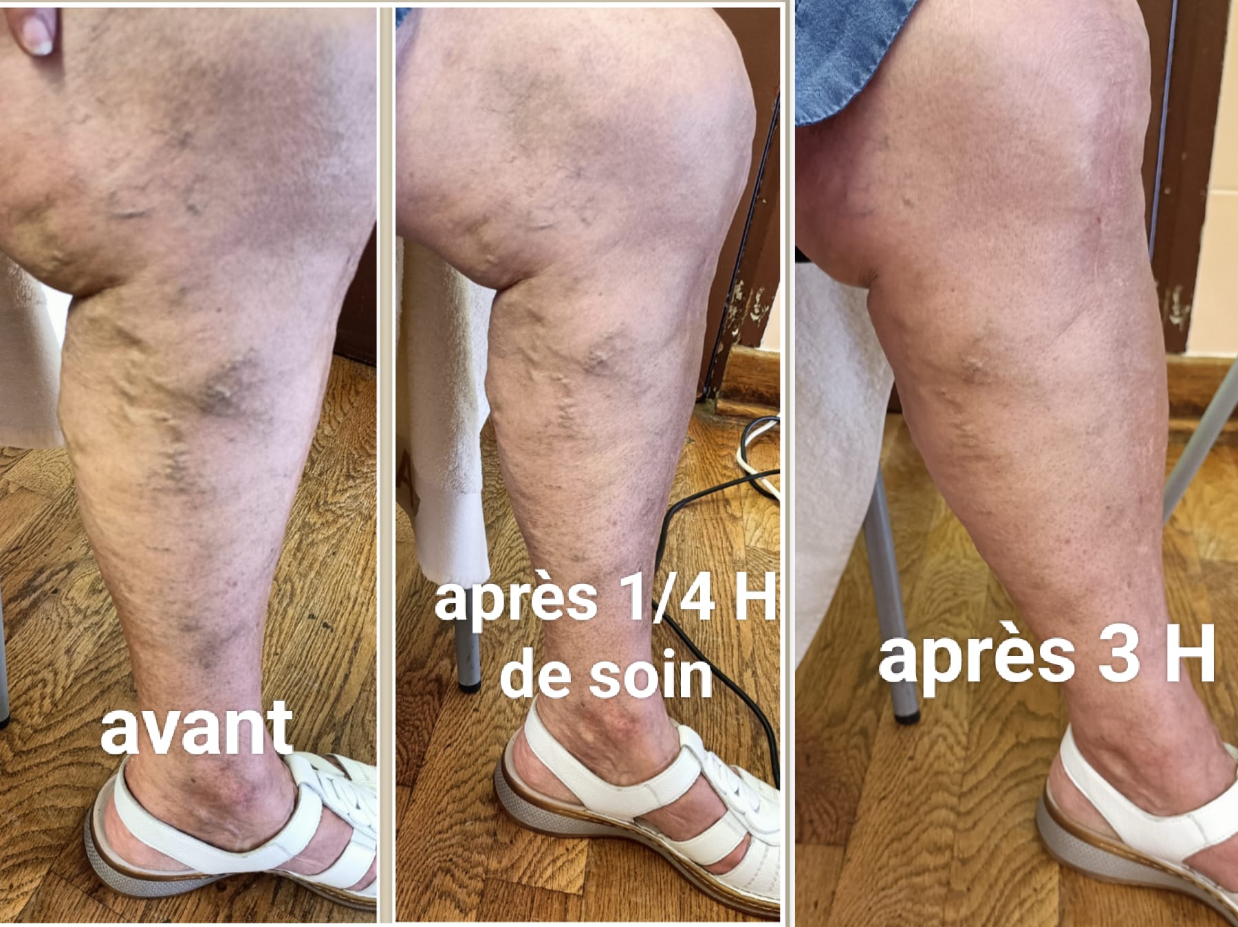 Soin à l'Iteracare Evolution des varices après 15 mn de l'IteraCare
