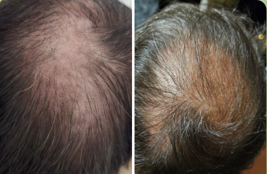 Repousse de cheveux en 1 mois avec l'IteraCare Repousse de cheveux en 1 mois