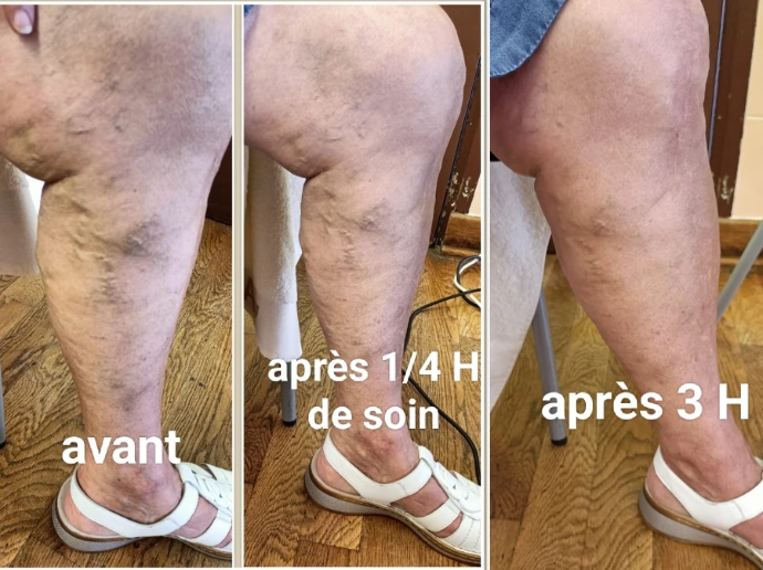 Comparaison avant, après 15 minutes et après 3 heures d’utilisation de l’Iteracare, montrant une évolution visible de l’aspect des zones concernées.