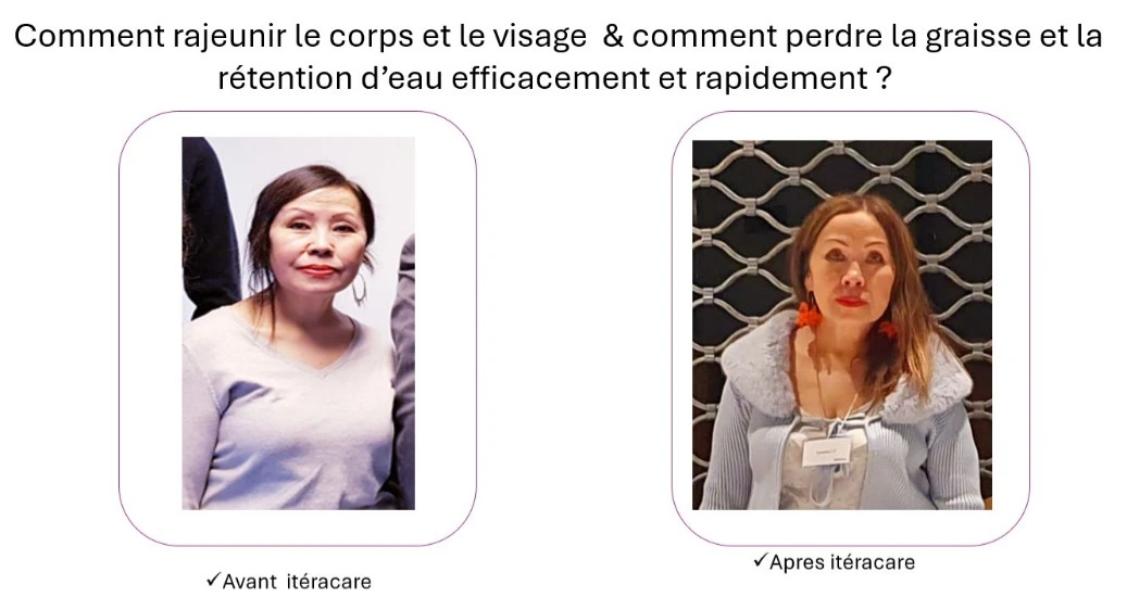 Comparaison avant / après utilisation de l’Iteracare : amélioration de l’aspect général du visage et du corps, avec diminution visible de la rétention d’eau et des paupières tombantes.