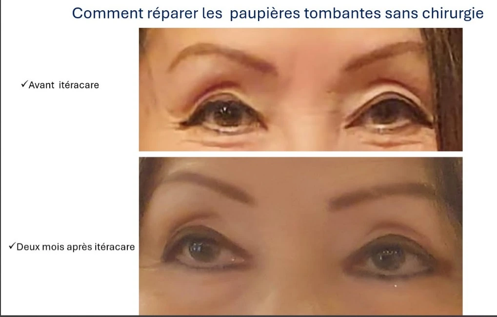 Photo avant après l'utilisation d'Iteracare sur des paupières tombantes
