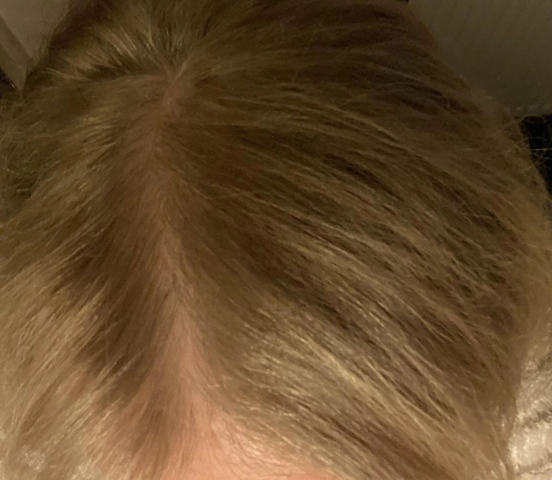 cuir chevelu qui ne comporte plus de cheveux blanc suite à l'utilisation de l'appareil iteracare