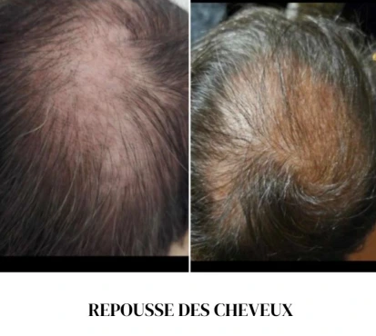 Avant / après utilisation de l’Iteracare : amélioration de la densité et de l’éclat des cheveux, avec un aspect visiblement plus sain.