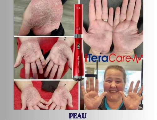 Évolution de l’état de la peau après utilisation de l’Iteracare associée à la consommation d’eau informée, montrant une peau visiblement plus nette.