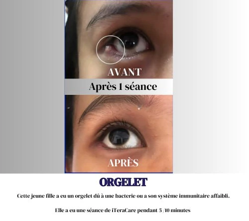 Diminution d’un orgelet après utilisation d’Iteracare