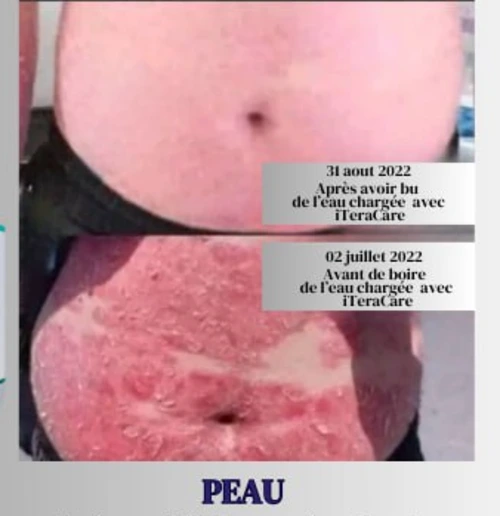 Évolution de l’état de la peau du ventre après utilisation de l’Iteracare associée à la consommation d’eau informée, montrant une peau visiblement plus nette.