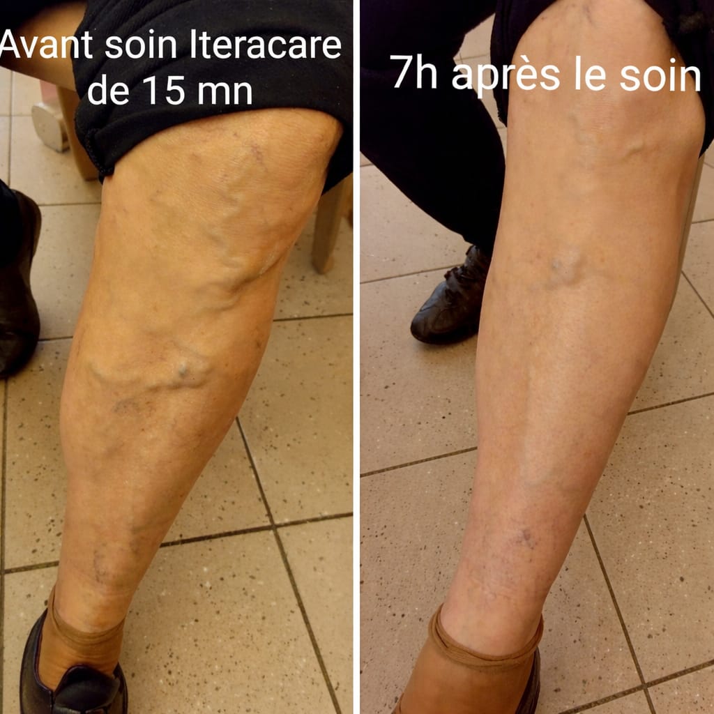 Comparatif avant et après une séance Iteracare sur les jambes montrant une amélioration de la circulation, un relâchement des tissus et une diminution visible des marques liées aux varices après utilisation de la technologie terahertz (THz)